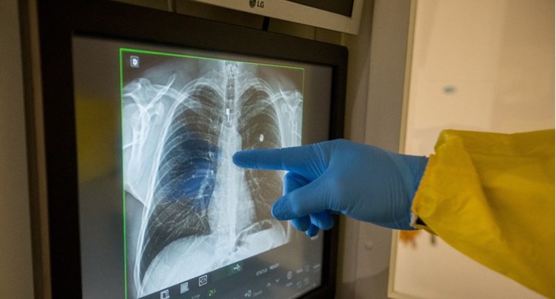 Kina tvrdi da se u Kazahstanu pojavila upala pluća opasnija od koronavirusa
