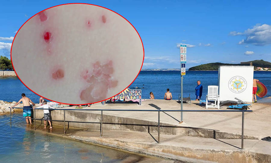 Gost prijavio fekalije na plaži otoka Ugljana: “Djeca su dobila infekciju!”